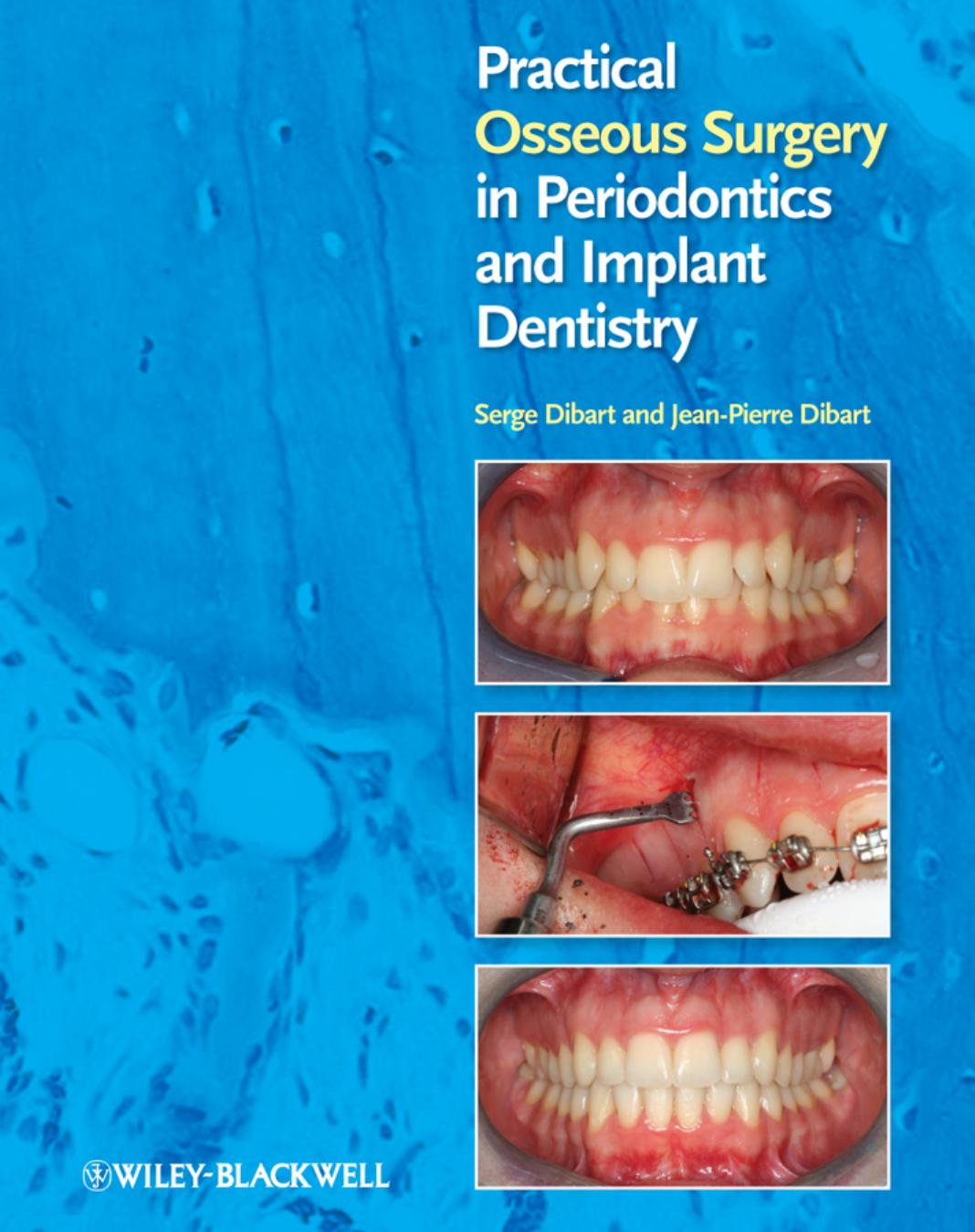 Practical Osseous Surgery in Periodontics and Implant Dentistry by Serge Dibart Jean-Pierre Dibart
