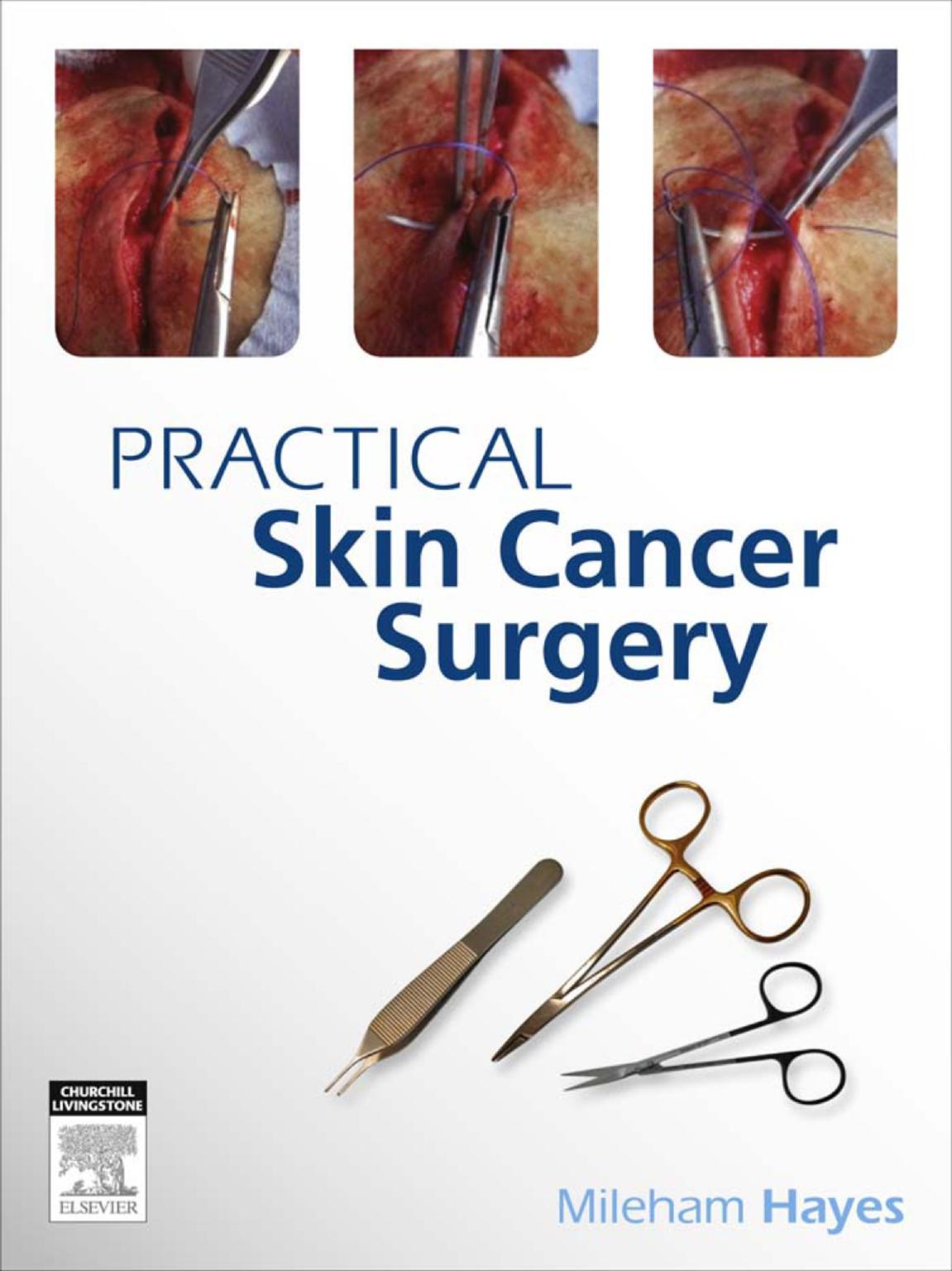 Practical Skin Cancer Surgery by Mileham Hayes