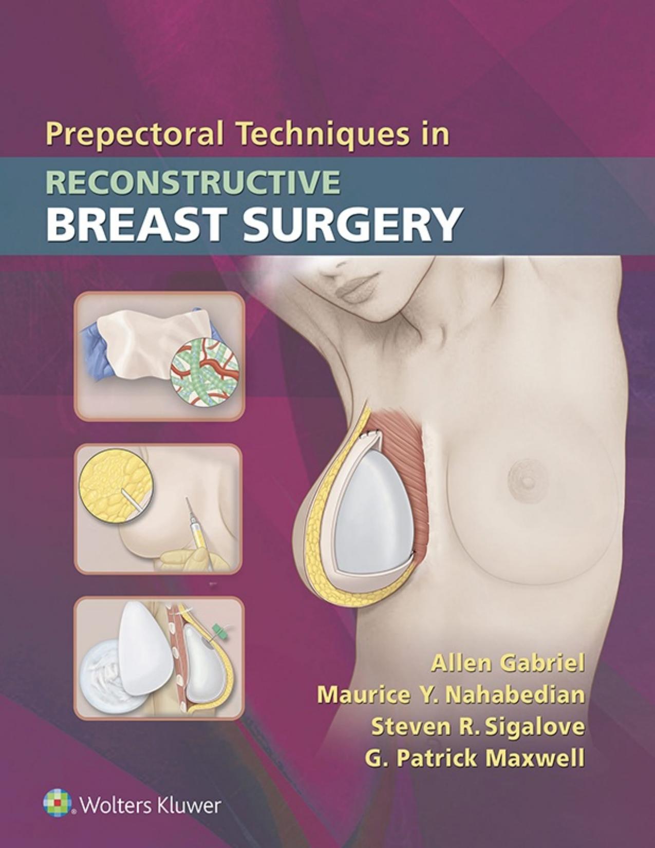 Prepectoral Techniques in Reconstructive Breast Surgery by Allen Gabriel Maurice Y. Nahabedian Steven R. Sigalove G. Patrick Maxwell