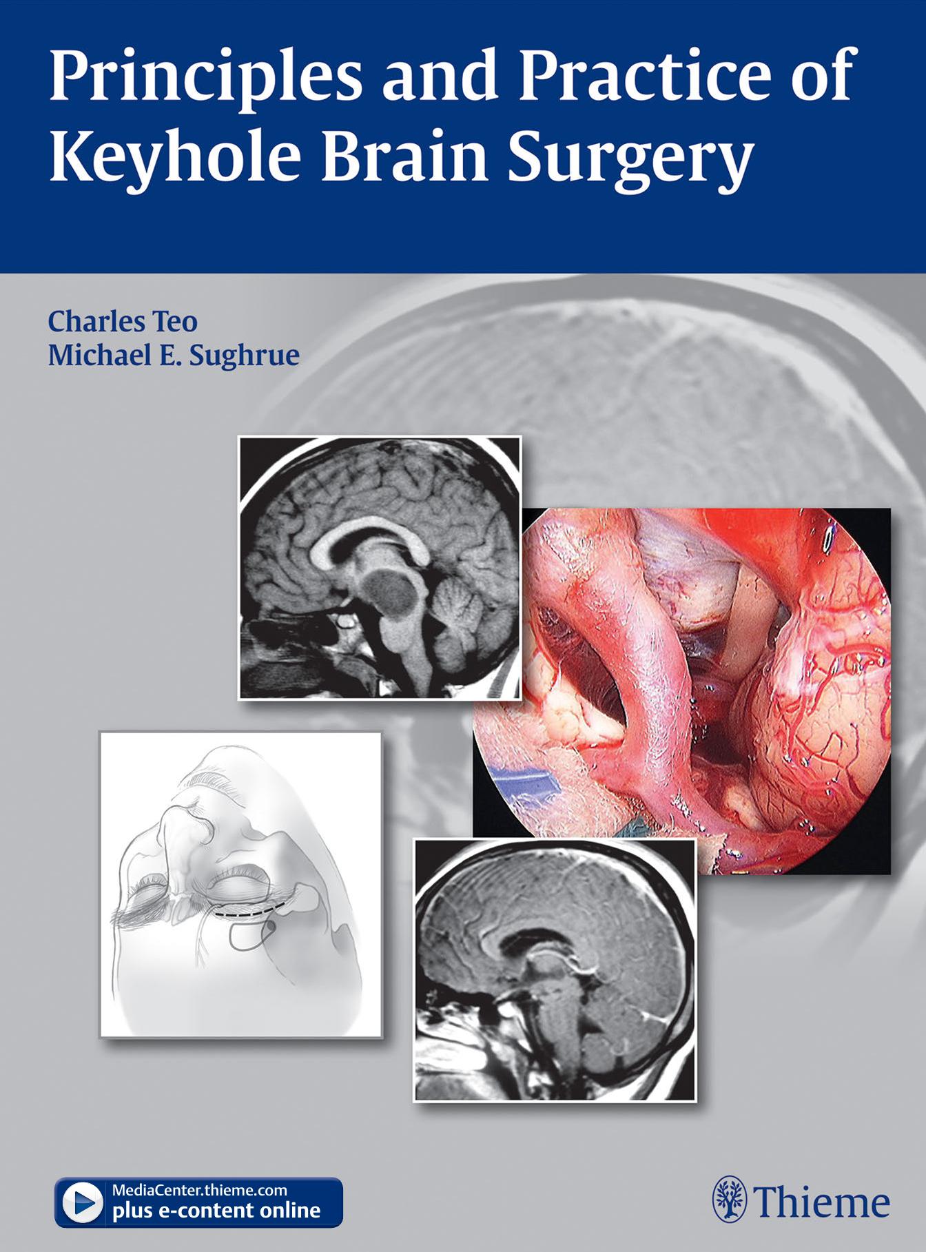 Principles and Practice of Keyhole Brain Surgery by Sughrue Michael E.; Teo Charles