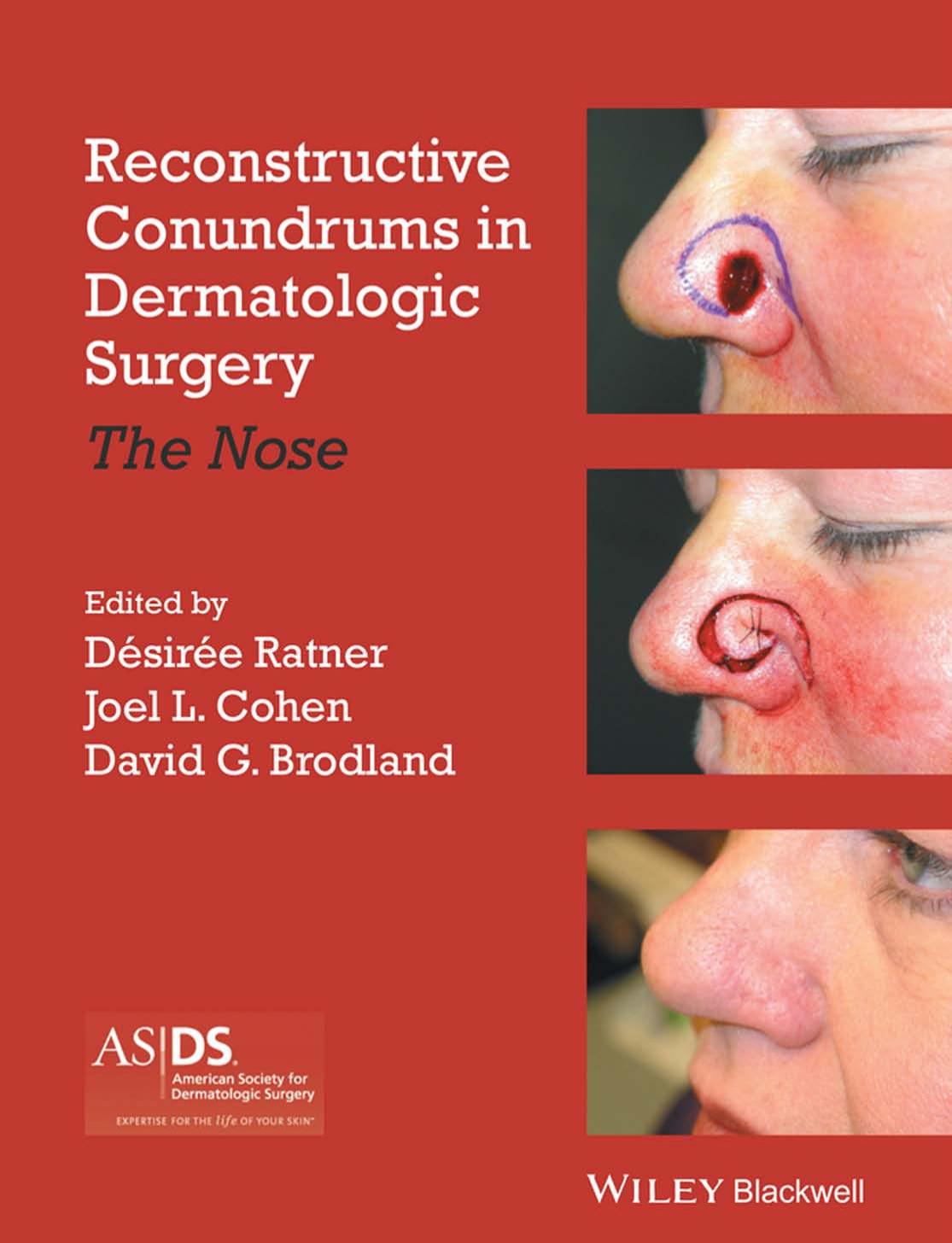 Reconstructive conundrums in dermatologic surgery : the nose by Cohen Joel L.; Ratner Desiree; Brodland David G