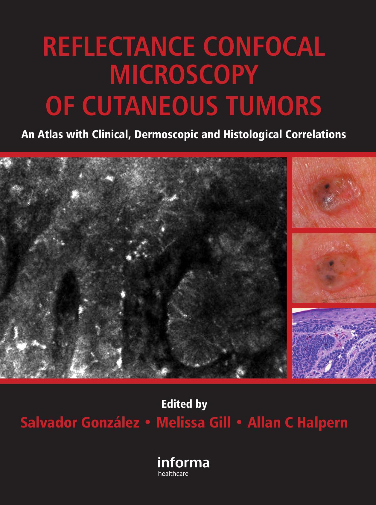 Reflectance Confocal Microscopy of Cutaneous Tumors: An Atlas with Clinical, Dermoscopic and Histological Correlations by Salvador Gonzalez Melissa Gill Allan C. Halpern