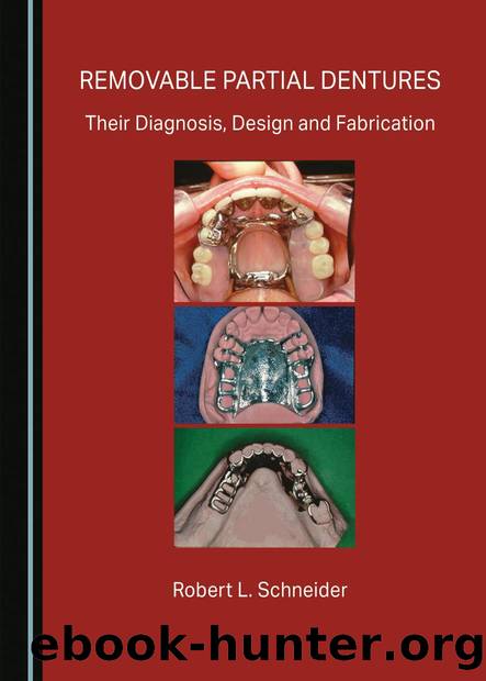 Removable Partial Dentures: Their Diagnosis, Design and Fabrication by Schneider Robert L