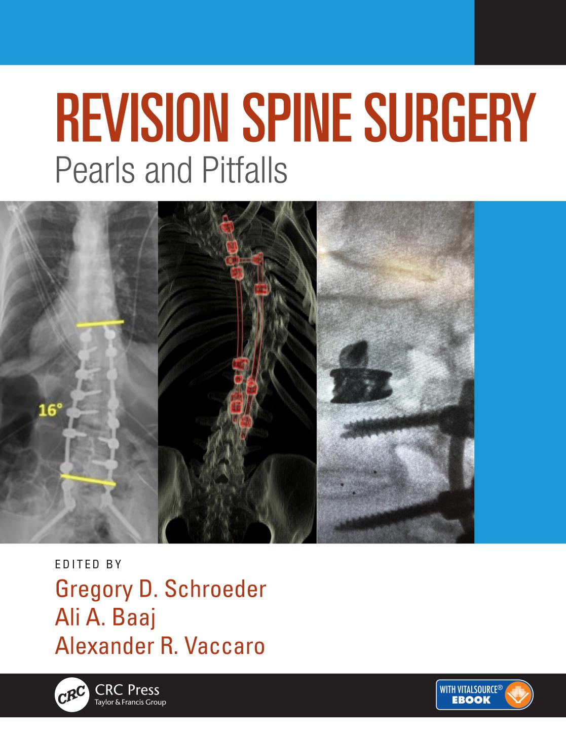 Revision Spine Surgery: Pearls and Pitfalls by Gregory D. Schroeder; Ali A. Baaj; Alexander R. Vaccaro