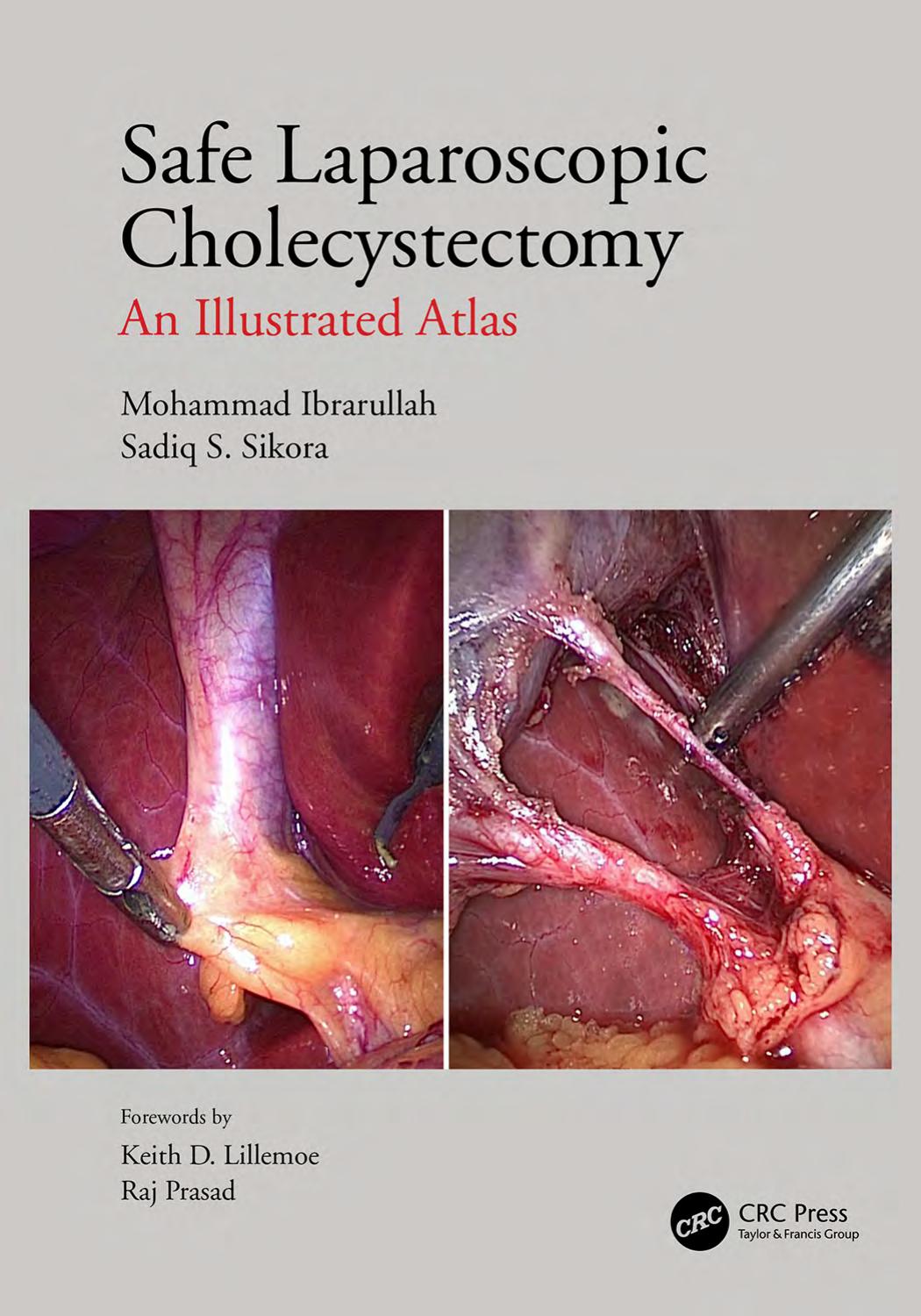Safe Laparoscopic Cholecystectomy: An Illustrated Atlas by Mohammad Ibrarullah Sadiq S Sikora