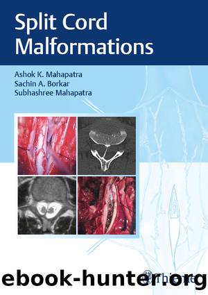 Split Cord Malformations by Ashok K. Mahapatra Sachin A. Borkar Subhashree Mahapatra