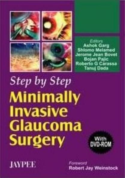 Step by Step Minimally Invasive Cataract Surgery by Lin Garg