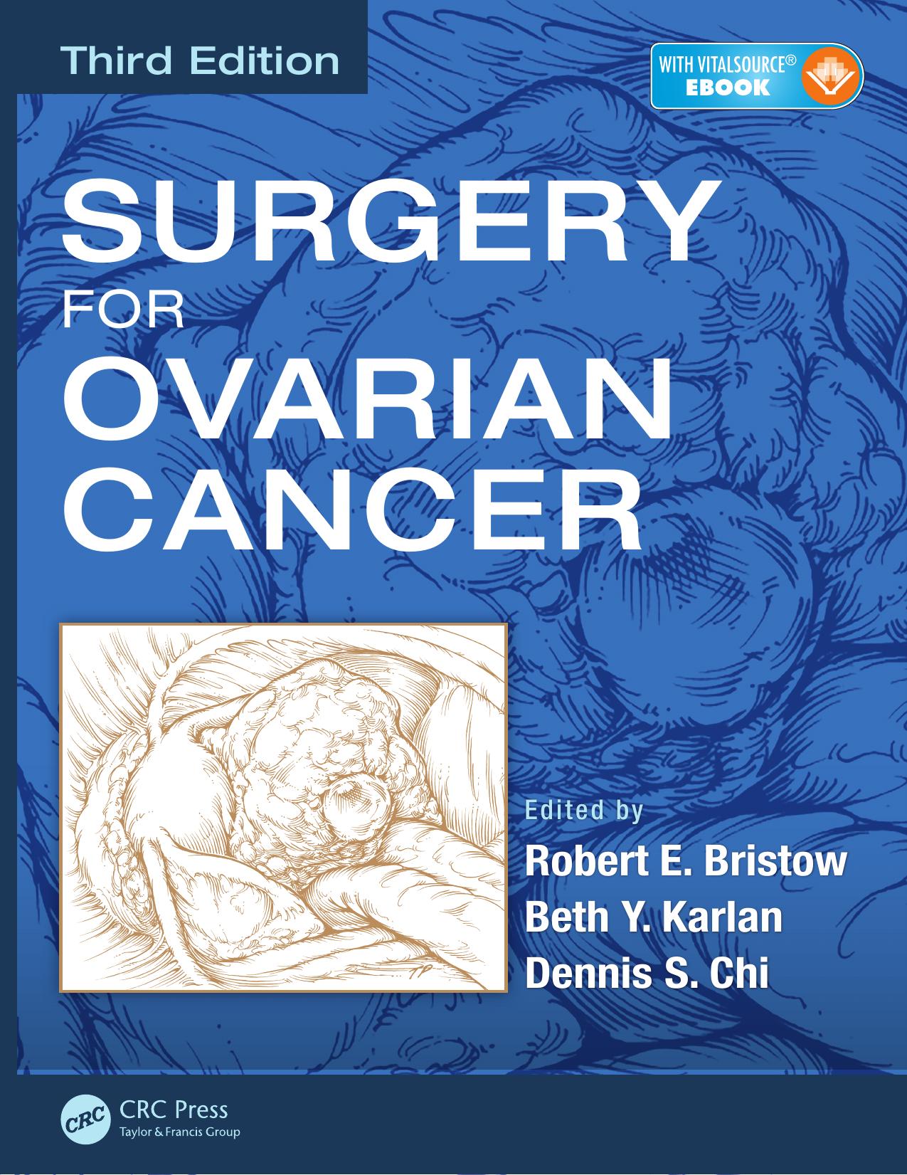Surgery for Ovarian Cancer by Bristow Robert E.; Chi Dennis S.; Karlan Beth Y