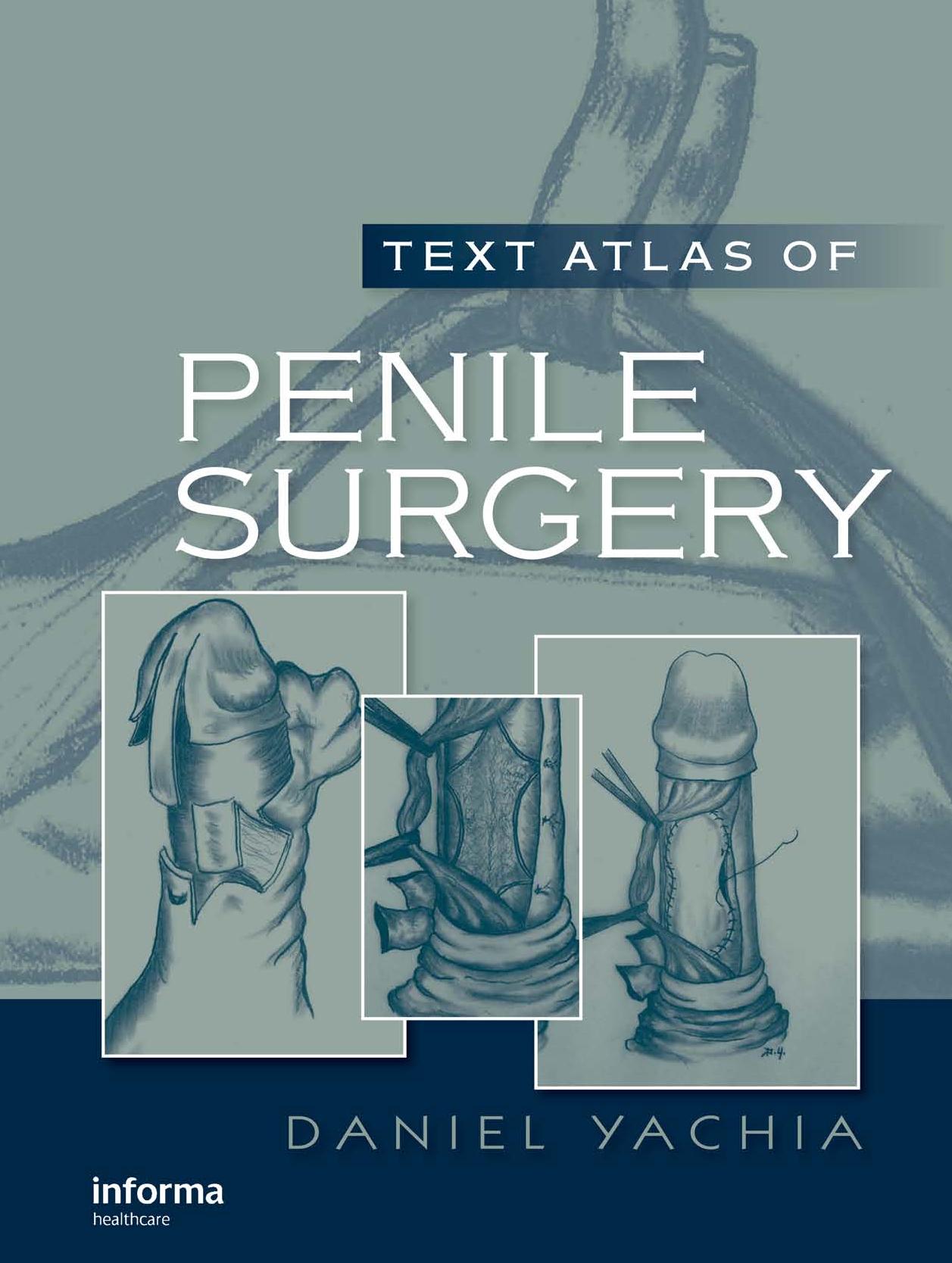 Text Atlas of Penile Surgery by Yachia Daniel