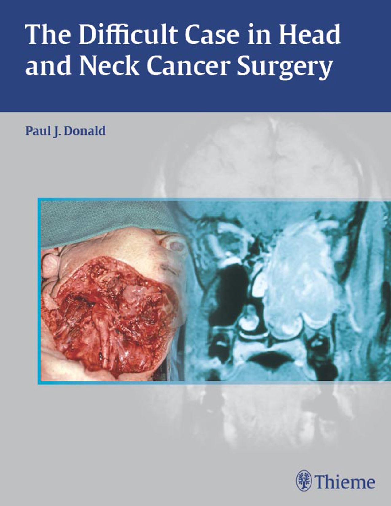 The Difficult Case in Head and Neck Cancer Surgery by Paul J. Donald