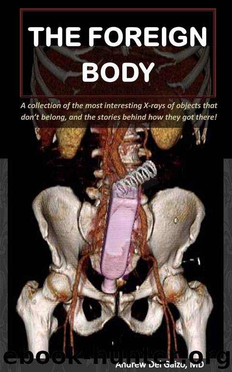 The Foreign Body: A collection of the most interesting X-rays of things that don’t belong and the stories behind how they got there! by Del Gaizo Andrew