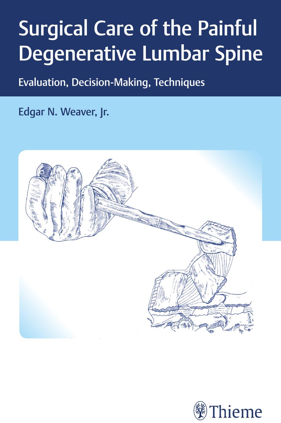 Thieme: Surgical Care of the Painful Degenerative Lumbar Spine: Evaluation, Decision-Making, Techniques by Weaver Edgar N.; James B. Macon; Lydia Prokosch