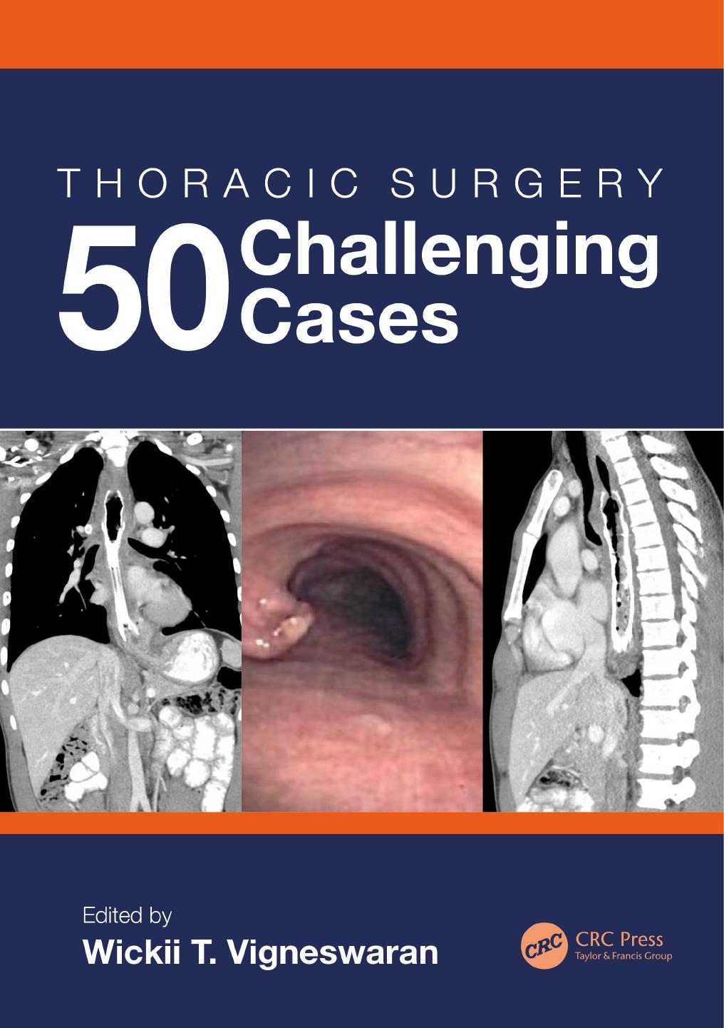 Thoracic Surgery: 50 Challenging Cases by Wickii T. Vigneswaran