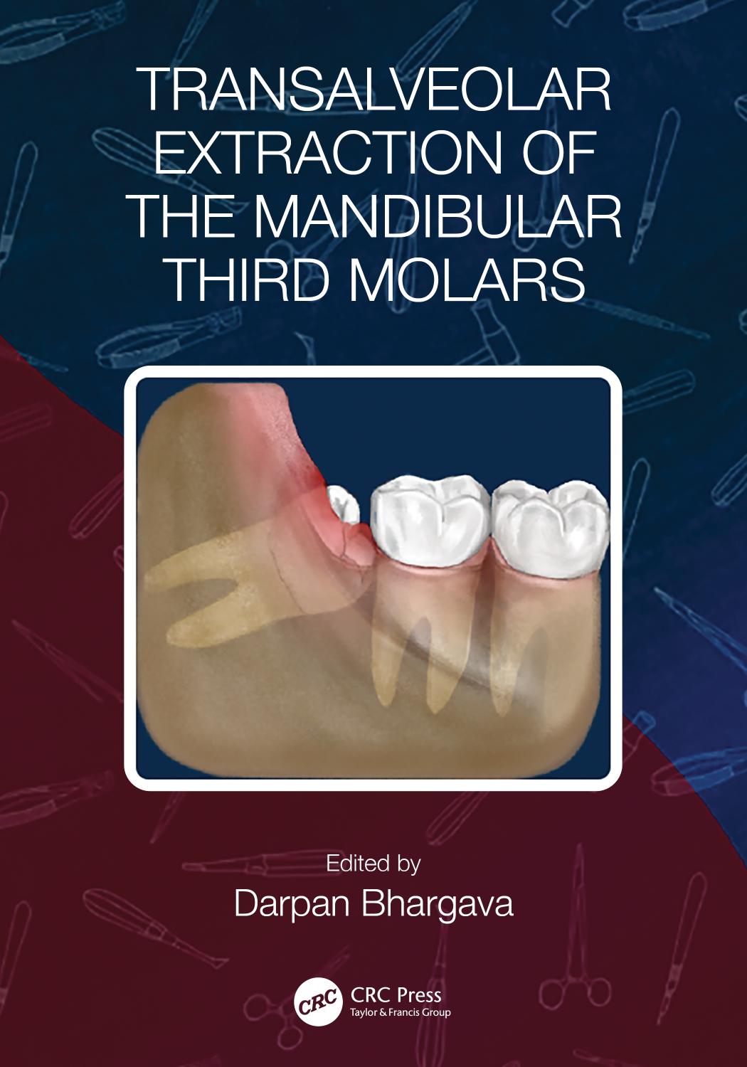 Transalveolar Extraction of the Mandibular Third Molars by Darpan Bhargava