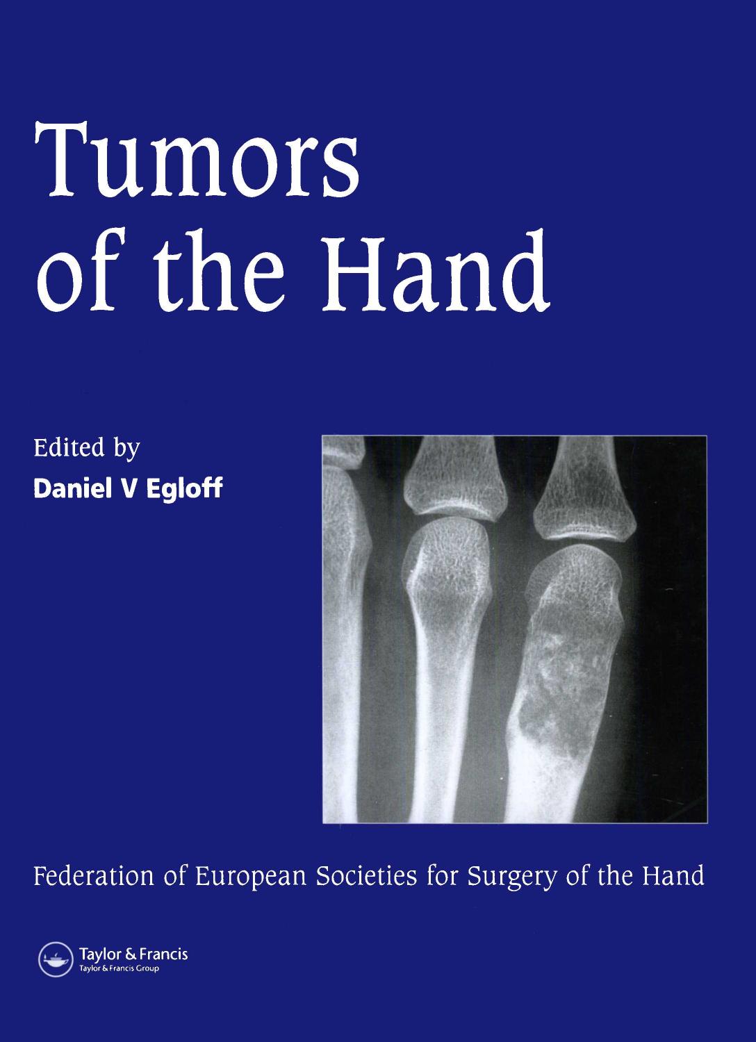 Tumors of the Hand: Published in association with the Federation of European Societies for Surgery of the Hand by Unknow