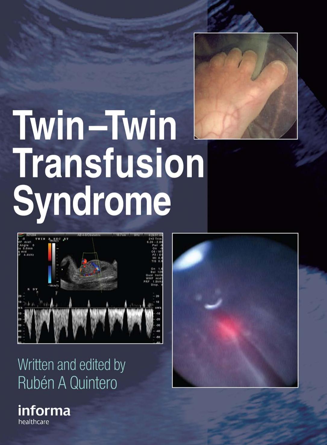 Twin-Twin Transfusion Syndrome by Rubén A. Quintero