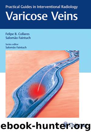 Varicose Veins by Felipe Collares Salomao Faintuch