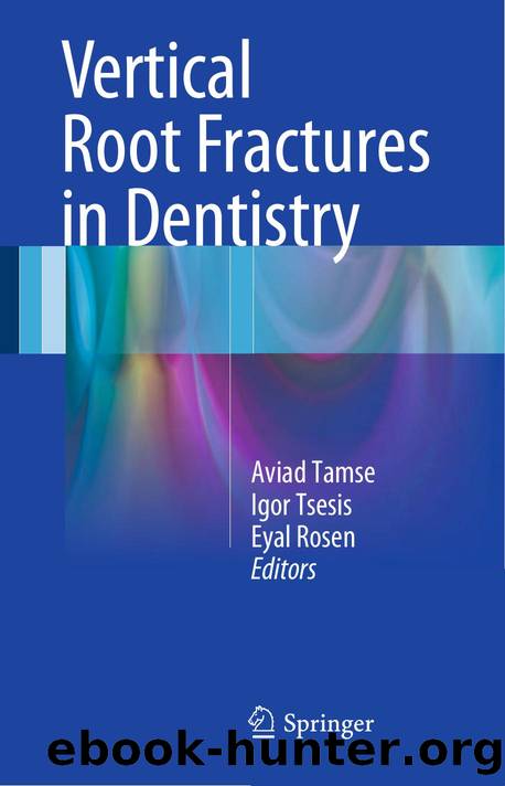 Vertical Root Fractures in Dentistry by Aviad Tamse Igor Tsesis Eyal Rosen