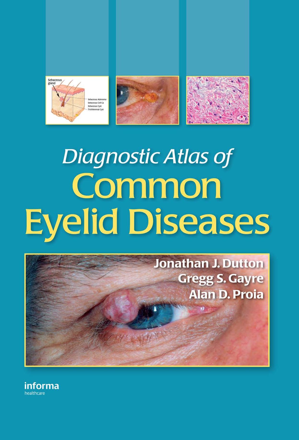 diagnostic atlas of common eyelid diseases by Unknown